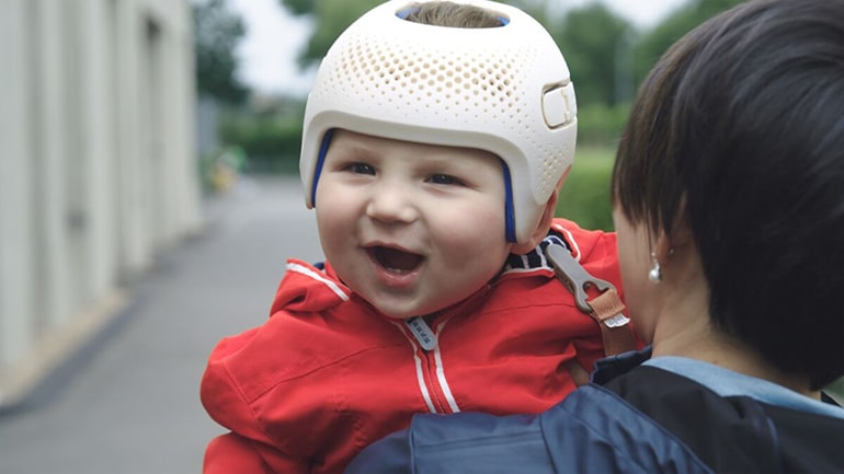 De Hoogstraat Orthopedietechniek boekt zeer succesvolle resultaten met nieuwe 3D-geprinte redressiehelmen